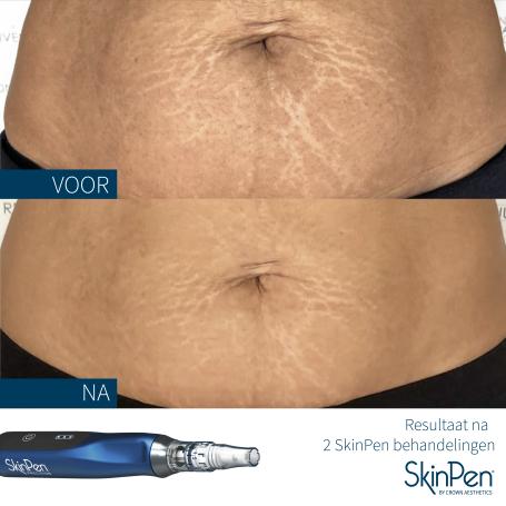 SkinPen-voor-en-na-2-behandelingen-skinrejuvenationclinic-uk.jpg