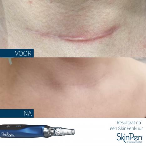 SkinPen-voor-en-na-skinpenkuur-huidtherapie-eemland-litteken-hals.jpg
