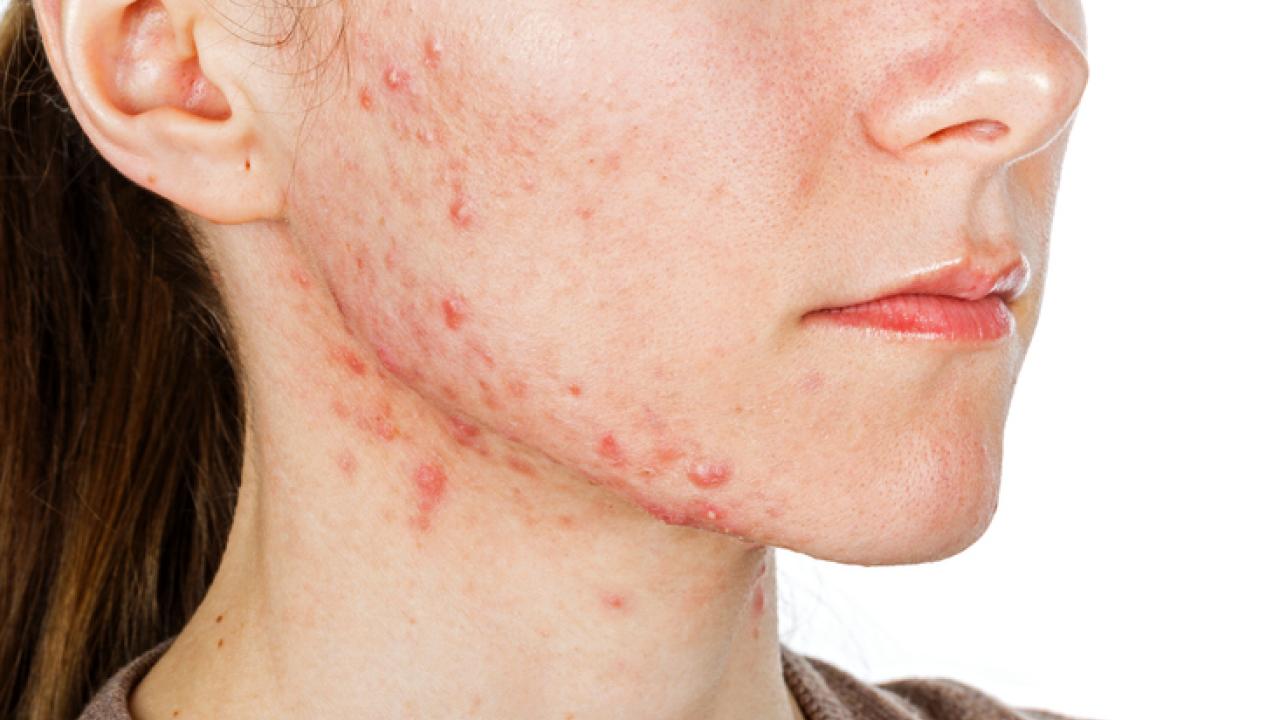 Verschillende soorten acne!