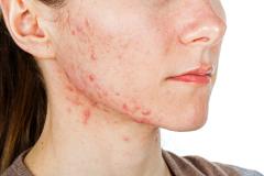 Verschillende soorten acne!