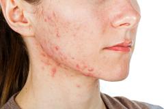 Verschillende soorten acne!