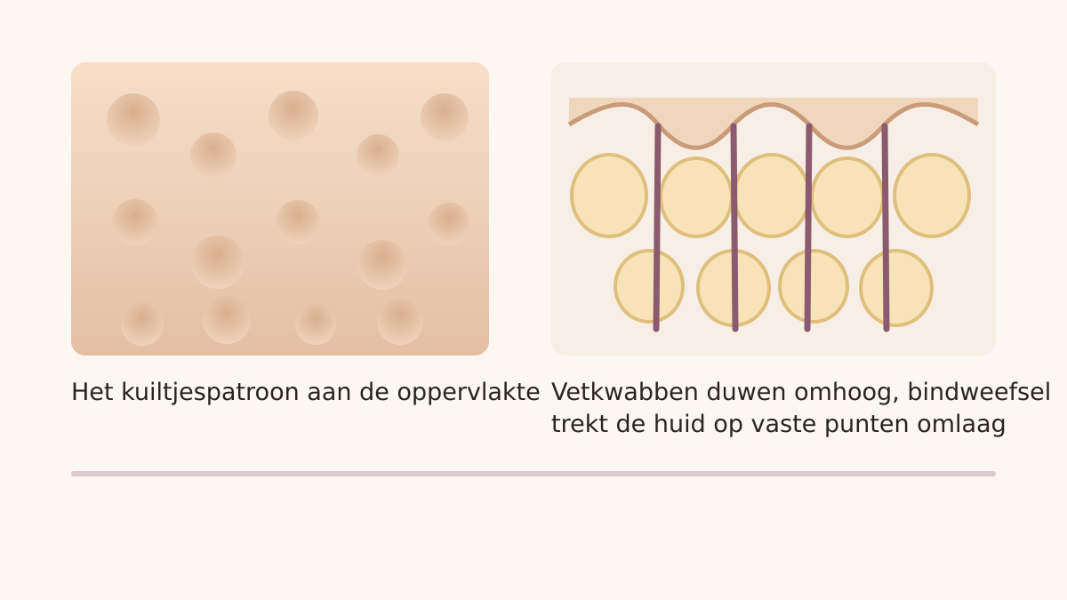Illustratie van het ontstaan van een sinaasappelhuid in doorsnede