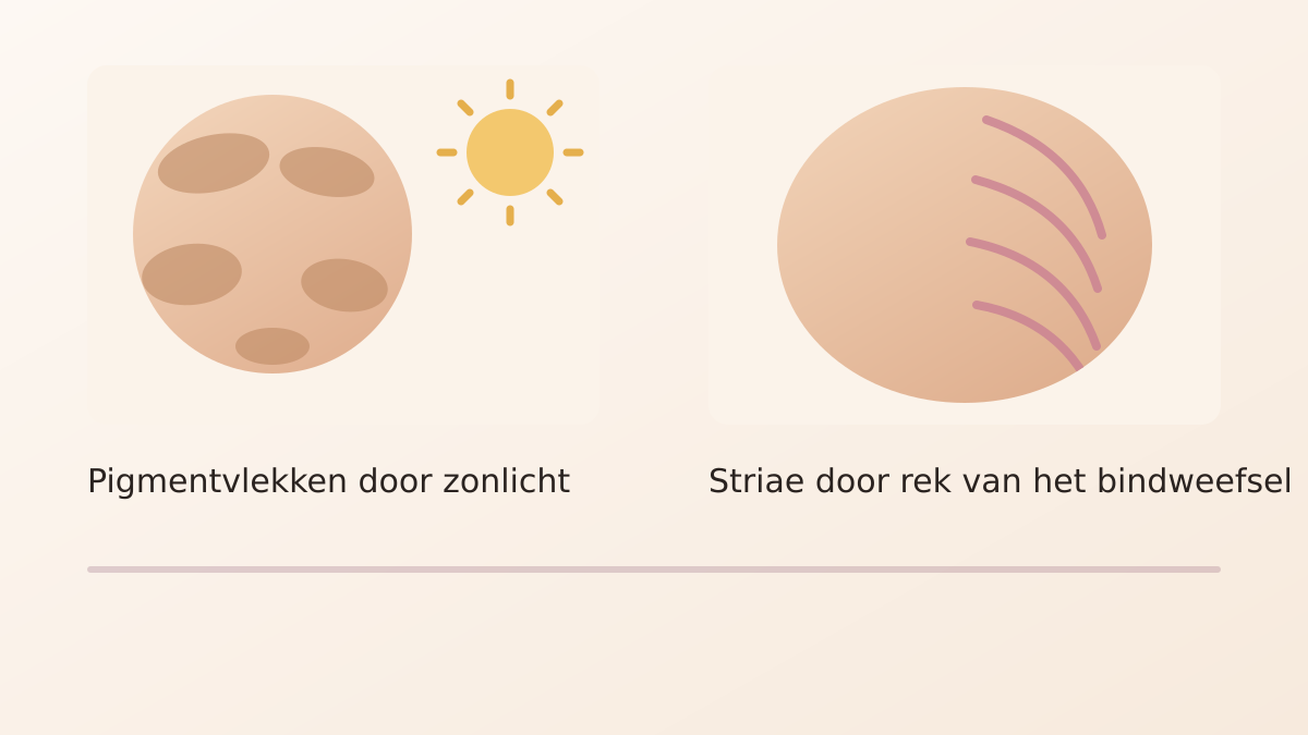 Illustratie van pigmentvlekken en striae tijdens de zwangerschap